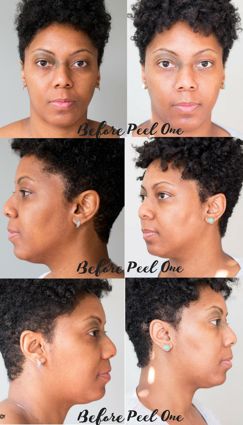 Before and AFter Chemical Peel One at About Face Skincare Philadelphia #melodysaboutface 