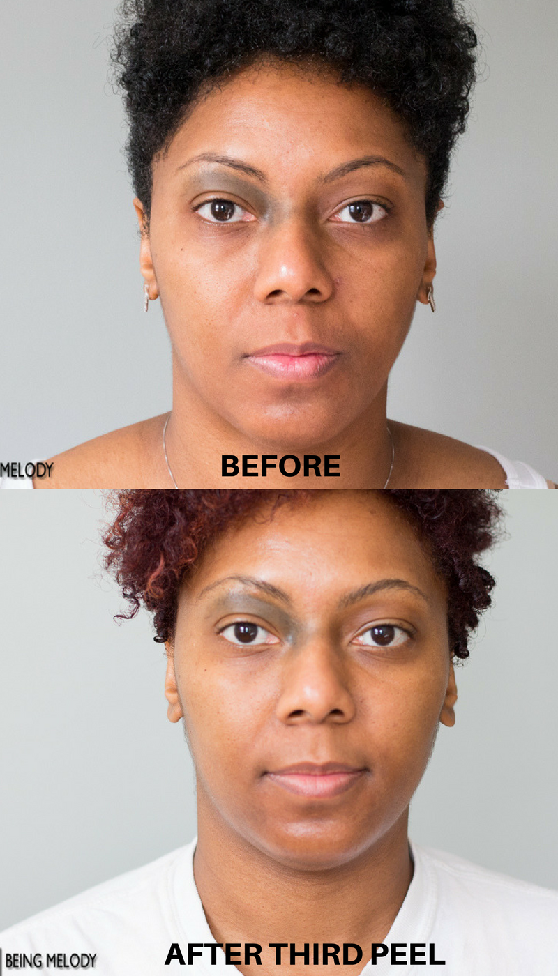 Before Chemical Peel and After Third Chemical Peel #melodysaboutface